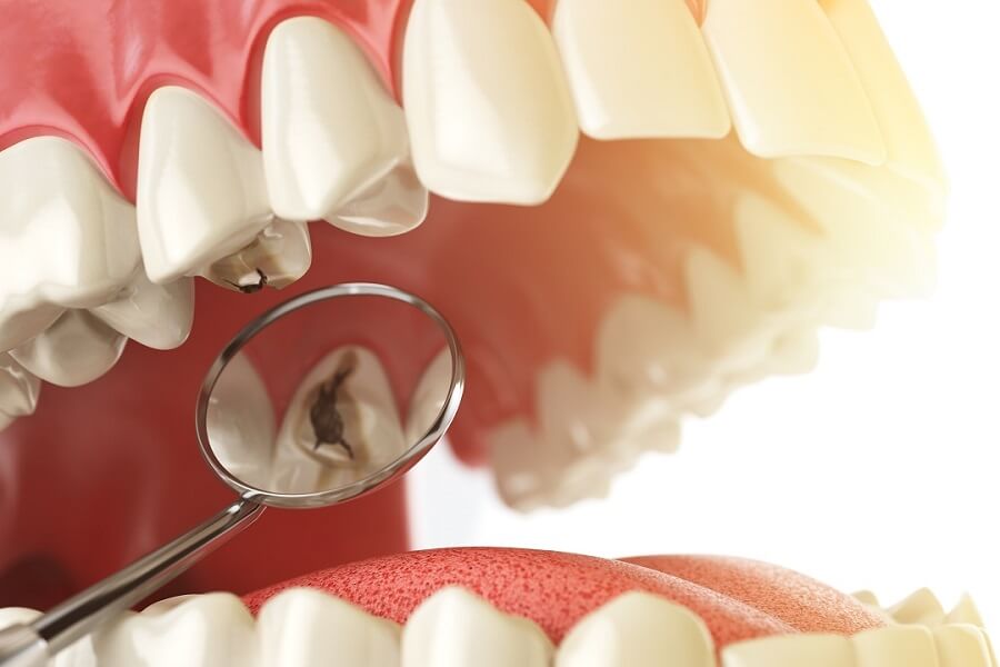 Restorations - DH Dental Lahore Pakistan